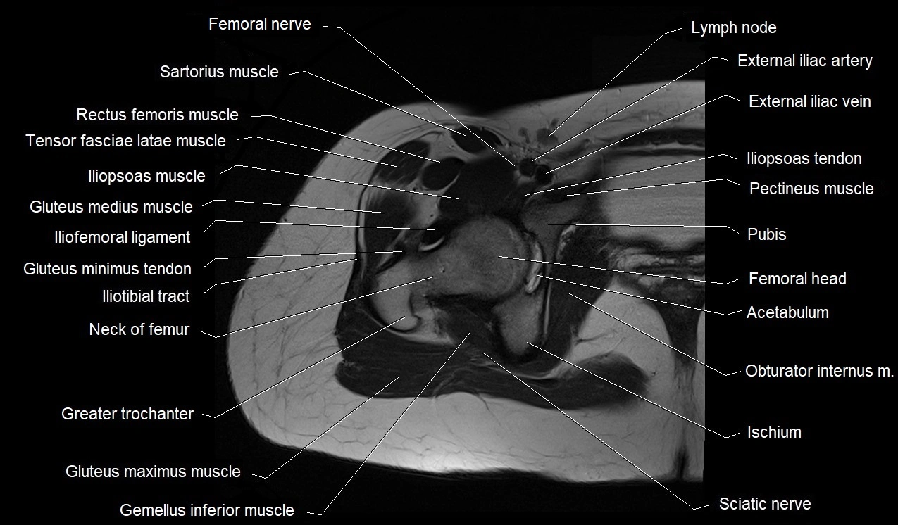 MRI thigh cross sectional anatomy image 8.webp
